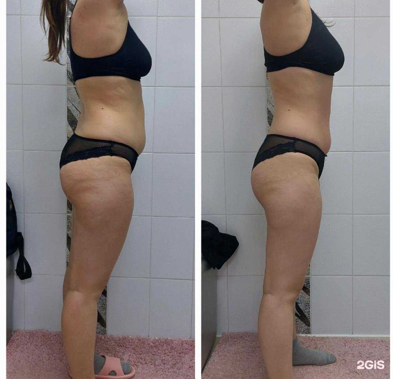 Отзывы на компанию Lpg slim body в Комсомольске-на-Амуре c фото