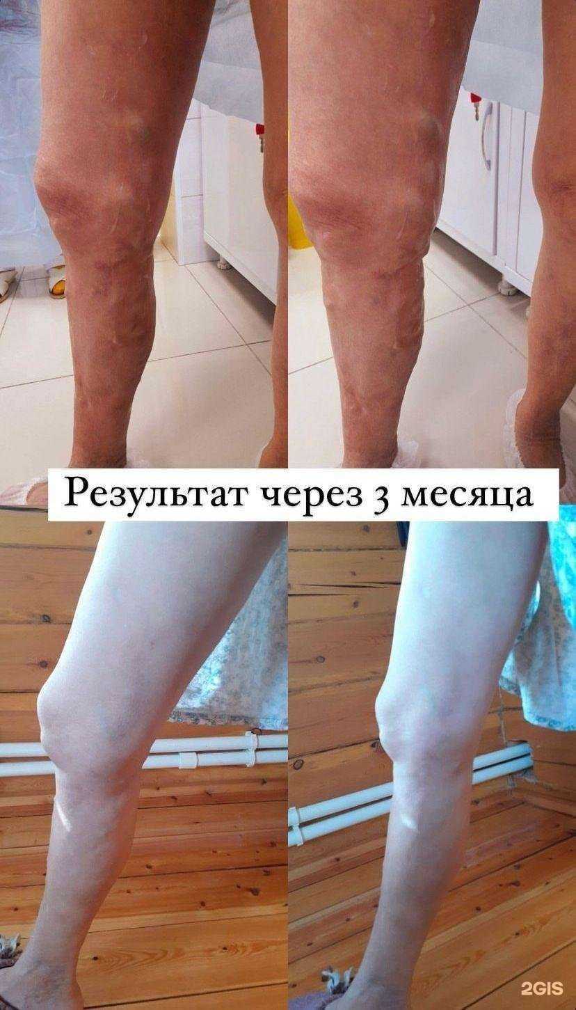 Отзывы на компанию Варикоза нет в Якутске c фото